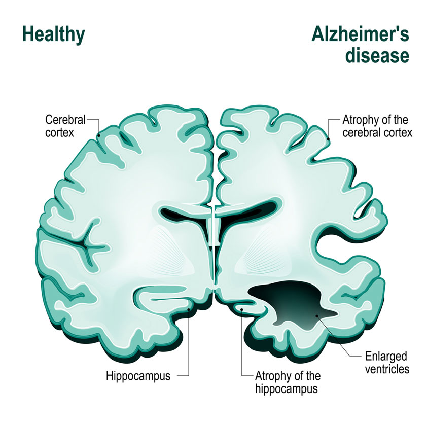 What Happens To The Brain Of Alzheimer's Patients?